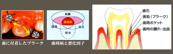歯周病について