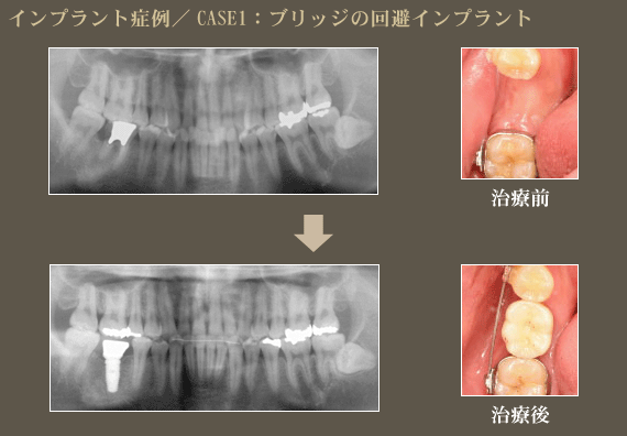 インプラント症例1