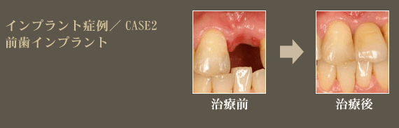 インプラント治療症例2