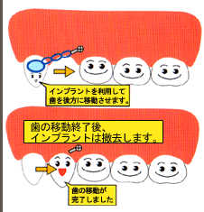 インプラント矯正